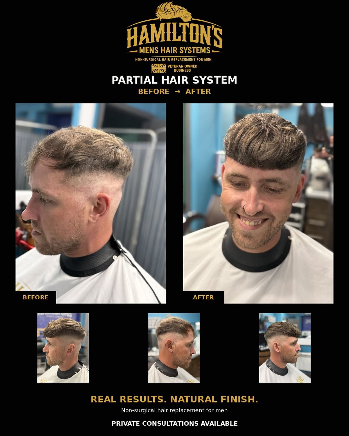 Hamilton's partial hair system before and after result