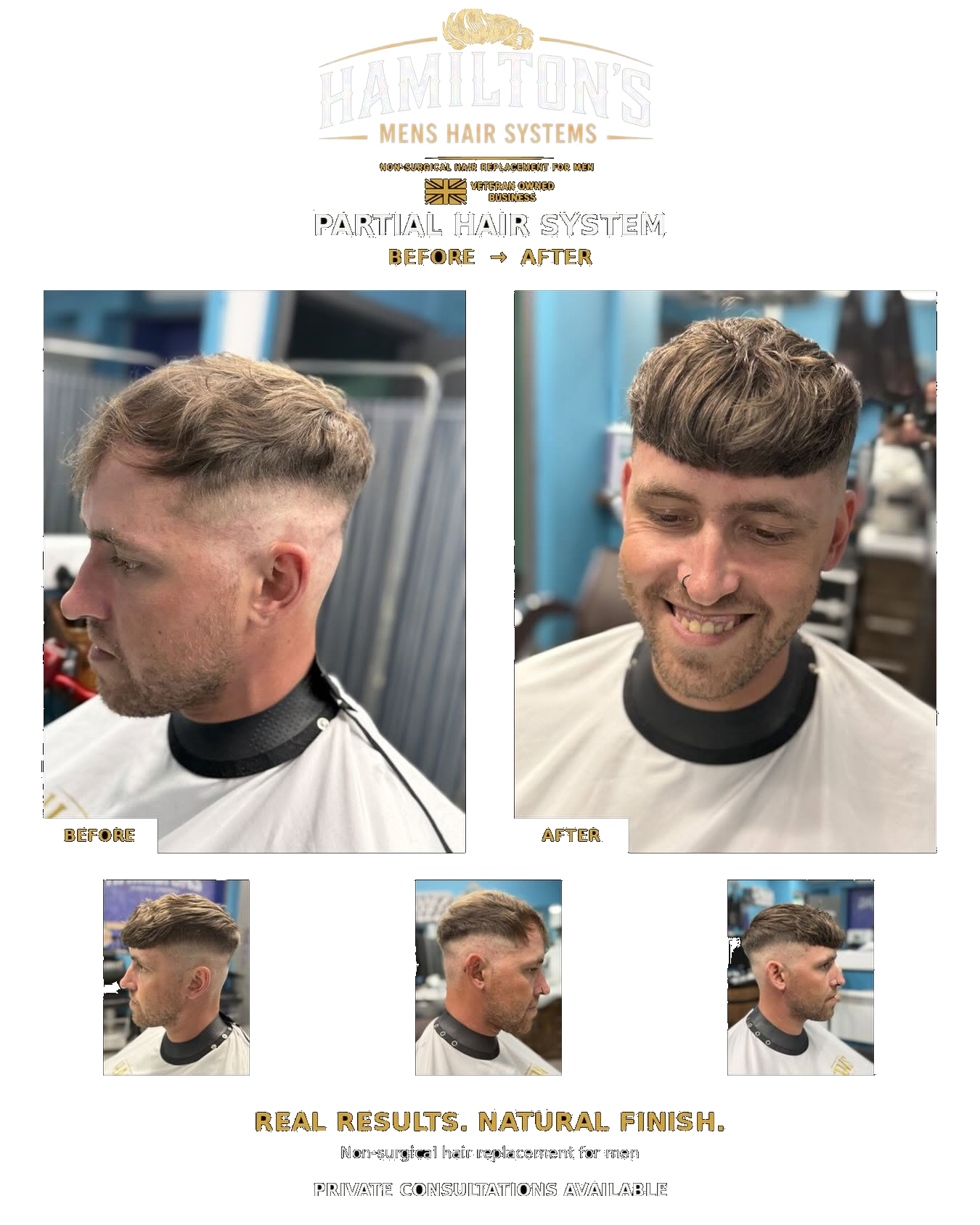 Hamilton's partial hair system before and after result
